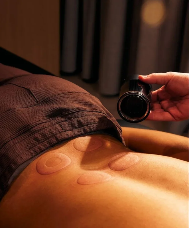 Terapia de ventosas en Skin Co.